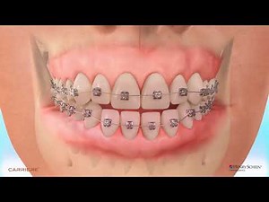Carriere® Motion™ Appliance for Class III Correction Patient Education Animation