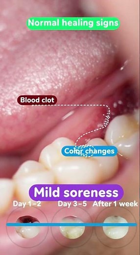🦷 What Does a Normal Healing Socket Look Like?