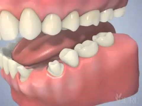 Pose de bridges en céramique pose bridge dentaire ceramique