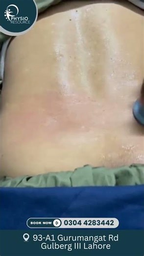 Soft Tissue Mobilization with Dynamic Cupping #shorts