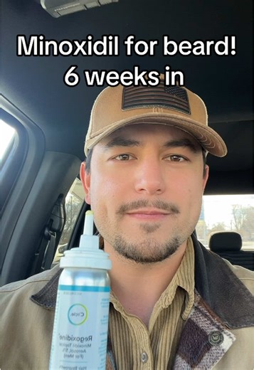 6 weeks into using minoxidil Rogaine) to fill in and thicken my beard! I’ve seen some results so far and no side effects. I’d say it’s going well! #minoxidil #beardgrowth