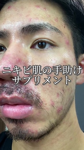 ニキビ肌改善サプリメントの効果とおすすめ