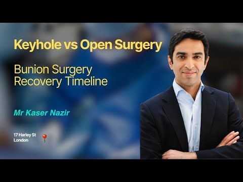 Bunion Surgery Recovery Timeline | Keyhole vs Open Surgery Explained by Mr Kaser Nazir