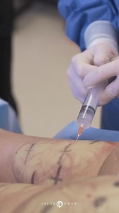 Targeting Cellulite with Cellfina