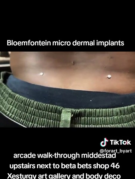 Micro Dermal Implants at Xesturgy in Bloemfontein