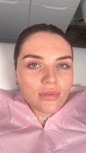 A moment for this beauty 💫 Less than 1.1ml top up leaving the lips completely natural, shaped and borderless with no risk of migration 🫶🏻 We are simply obsessed - What do you all think? Book in now with our talented injectors ⤵️🌍 Clinics all over the UK 📲 Use the link in bio for all appointment bookings 📈 Training academy @flawlessaestheticsacademy_ 📌 11 Years established #lipfiller #aesthetics #fullerlips | Flawless Cosmetic