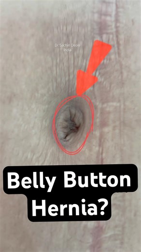 Belly Button Hernia (Umbilical Hernia) – Bulge Appears When Coughs | Laparoscopic Hernia Surgery