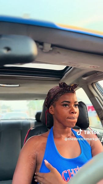 Embracing Stretch Marks for Body Confidence