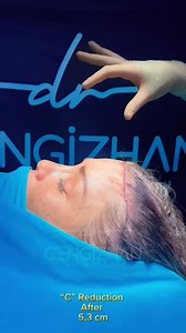 Forehead Reduction, Before and Immediately After Surgery