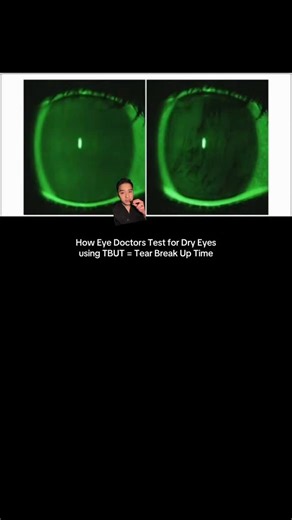 enVISIONaries | OD, MS, FAAO on Instagram: "A tear break up time is only one of many tools we use to diagnose and manage dry eyes. What TBUT did you get at the end? . . . . . . . #dryeyes #cornealneuralgia #eyedoctor #dryeyedisease #optometry #optometrist #explorepage #fyp #ophthalmology #eyes #eyehealth"