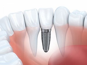 Dental Implants Near Me in Montclair, CA