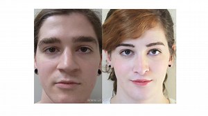 Facial Feminization Surgery with Dr. Spiegel