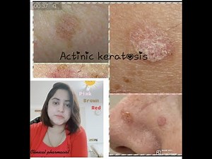 Actinic keratosis | Skin condition | Symptoms | Treatment