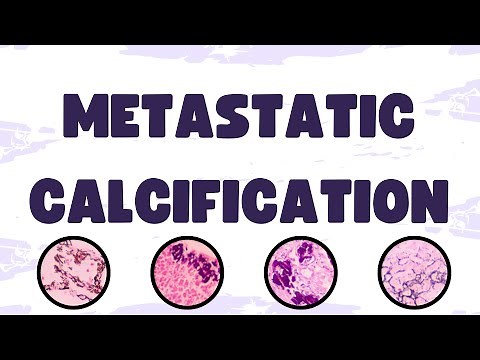 Metastatic Calcification