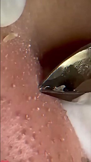 Skincare ｜ Blackheads Removal #tweezer #skincare #blackheads 11