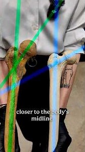 Coxa Valga vs Coxa Vara: How Femur Angles Change Anatomy