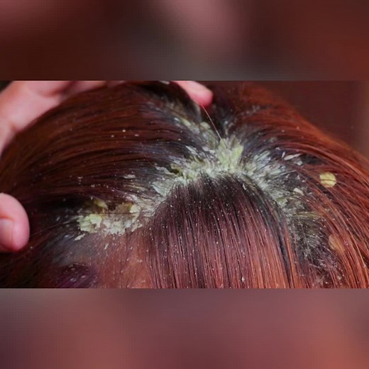 Dandruff ASMR on TikTok