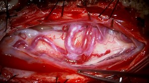 #427: Microsurgical Resection of a T9 Thoracic Intramedullary Spinal Cord Arteriovenous Malformation - Vascular Spine - Seven Series Collection