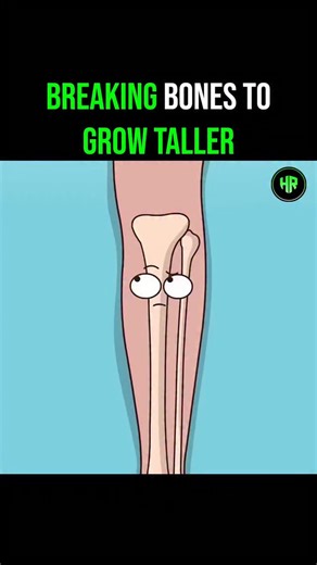 Healthrivex | Daily Health Tips on Instagram: "This animation visualizes the intense process of limb-lengthening surgery. The procedure involves surgically breaking the leg bone and inserting a metal rod and external fixator. Over time, this device slowly pulls the severed bone segments apart, forcing the body to fill the gap with new tissue. Although the patient successfully gains height, the doctor warns that the newly formed bone, called a "callus," remains soft and fragile. To avoid bending 