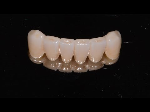 Replacing missing teeth with a fixed bridge