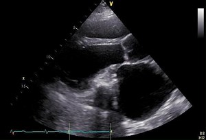 7.2K views · 76 reactions | New in #JACCCaseReports: What are potential complications after pericardiectomy? We describe a fascinating case of a chronic progressive constriction of the residual pericardium leading to mitral deformity. https://bit.ly/2G0stVF #cvEcho | JACC Journals | Facebook