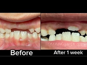 Gum Cut to facilitate Tooth Eruption| Painless Mucosal Cut done in a 7 Year Old|