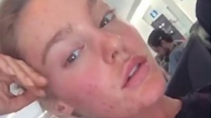Georgia Gibbs shares her battle with acne on her Instagram