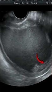 #sonobuzzshorts #postmenopausalbleeding