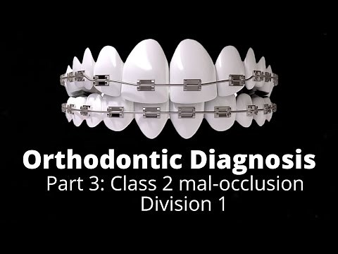 #orthodontics Treatment planning Part 3- Class 2 div 1 malocclusion, Orthodontic Courses Lecture