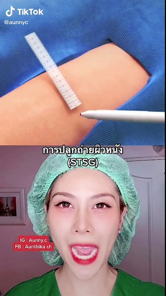 การปลูกถ่ายผิวหนัง #พยาบาล #aunnyc