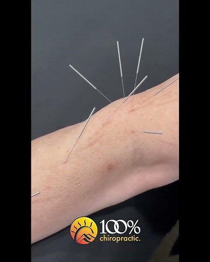 Tennis Elbow Acupuncture Treatment