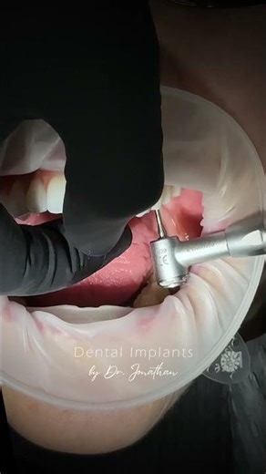 Xcell Dental Implants delivery: Before & After Transformation