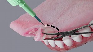 Partial Glossectomy