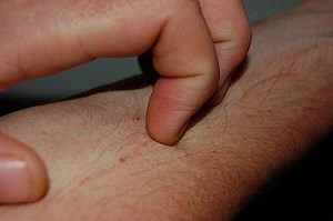 Nighttime Itching Reasons, Causes, Remedies, Treatment