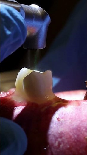 “Solea Laser: Precision 9.3-Micron Technology for Hard & Soft Tissue Dentistry”