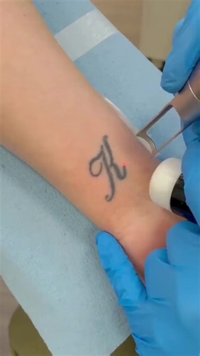 Tattoo Removal Process: Cursive Letter 'J' Demonstration