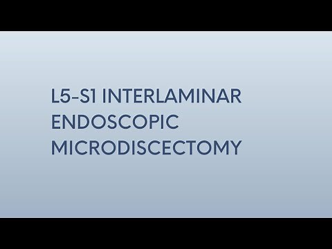 L5-S1 Interlaminar Endoscopic Microdiscectomy | Patient Success Story