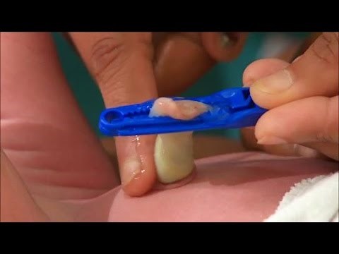 Chlorhexidine for Newborn Cord Care - Newborn Care Series