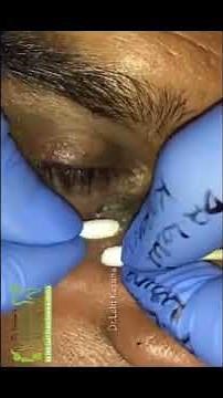 Under eyes blackheads removal/ Eyebags deep blackheads