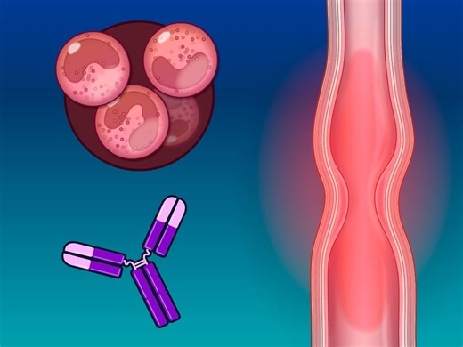 Effective treatment options are needed for eosinophilic esophagitis. One potential agent is benralizumab, an anti–interleukin-5 receptor α monoclonal antibody used to treat eosinophilic asthma. Research findings are summarized in a new Quick Take video. https://nej.md/3L2xScB | The New England Journal of Medicine