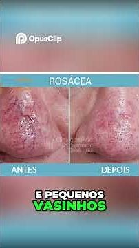 😳 Redness on your face? Understand Rosacea and how to treat it! 💡