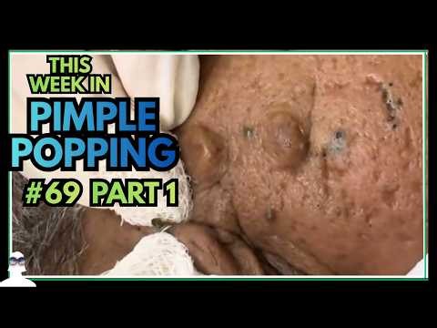 This Week In PIMPLE POPPING #69 Part ONE