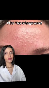 4.4K views · 13 reactions | Fungal acne causes clusters of small, itchy, red bumps on your skin. Antifungal medications can treat the infection (Ketoconazole cream). Also anti-dandruff shampoos can treat it (Nizoral shampoo). #fungalacne #foreheadbumps #acne | Dr. Farzan | Facebook