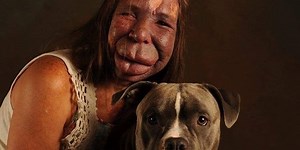 Tuscaloosa woman brings awareness to Sturge-Weber Syndrome