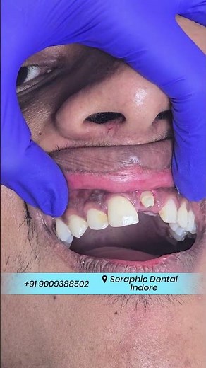 Front Tooth Crown Lagte Hi Smile Change! 😱🦷