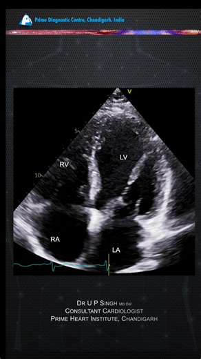 U P Singh on Instagram: "🚨 Cirrhosis + Hypoxia? Think Pulmonary AV Fistulas! Watch Now: https://youtube.com/shorts/wKEyhq2eV-0 🫁🫀 Pulmonary AV fistulas in cirrhosis, usually part of hepatopulmonary syndrome (HPS), occur due to intrapulmonary vascular dilatation causing right-to-left shunting. Patients may present with unexplained hypoxemia 😮‍💨, dyspnea, or platypnea–orthodeoxia 📉. Diagnosis 🔍 is best made with contrast (bubble) echocardiography 🫧, showing delayed bubbles in the left hear