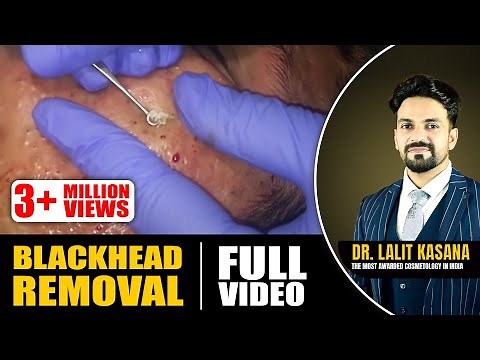 BLACKHEAD REMOVAL FULL VIDEO
