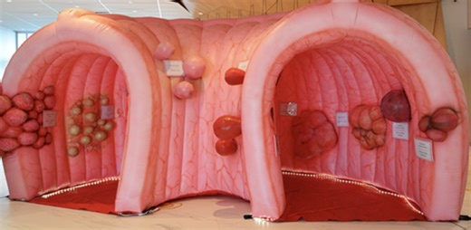Schenectady health expo to feature giant inflatable colon
