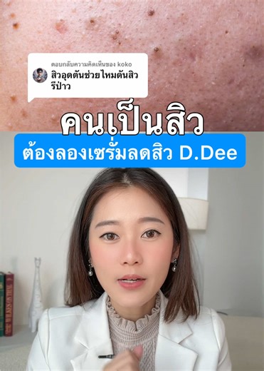 ตอบกลับ @koko เซรั่มสิวสำหรับคนเป็นสิว ที่หมอแนะนำว่าต้องมี !! #ddee #รีวิวDDee #รักษาสิวด้วยตัวเอง #ยารักษาสิว #ddeeskincare