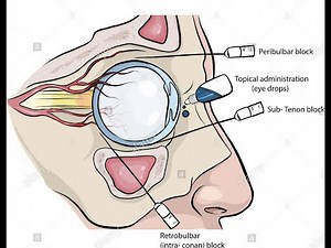 Peribulbar and retrobulbar Block for eye surgery